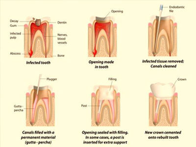 Diagram of Root Canal treatment