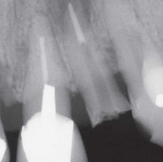 After Root Canal treatment