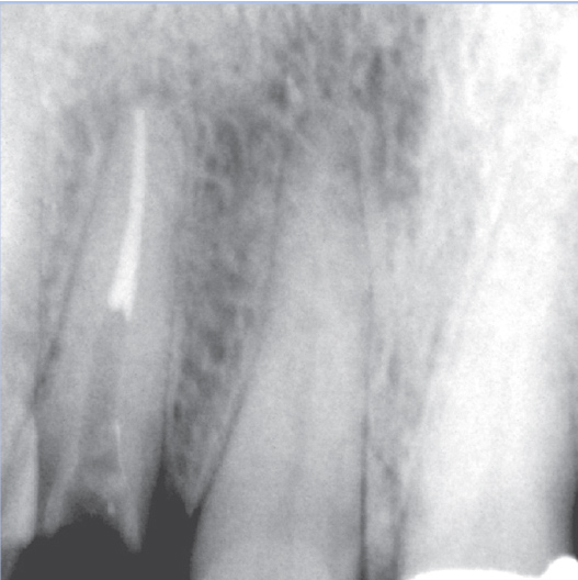 After Root Canal treatment