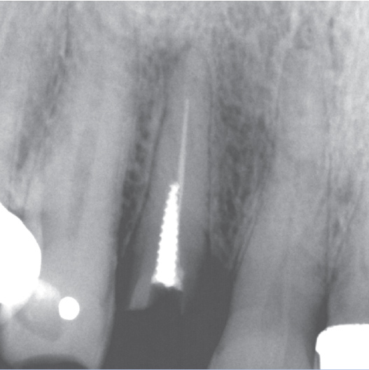 Before Root Canal treatment