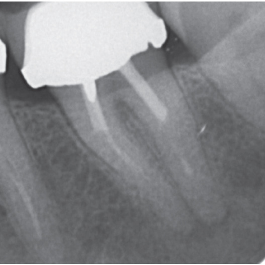 Before Root Canal treatment