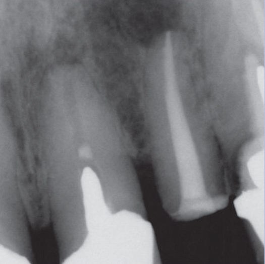 After Root Canal treatment