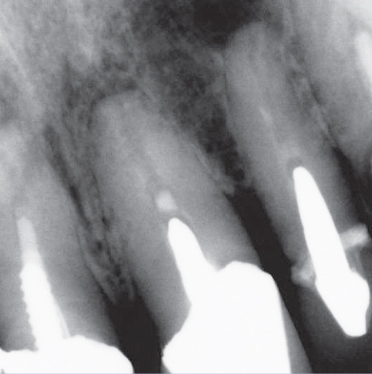 Before Root Canal treatment