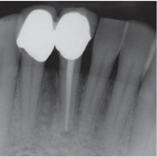 After Root Canal treatment