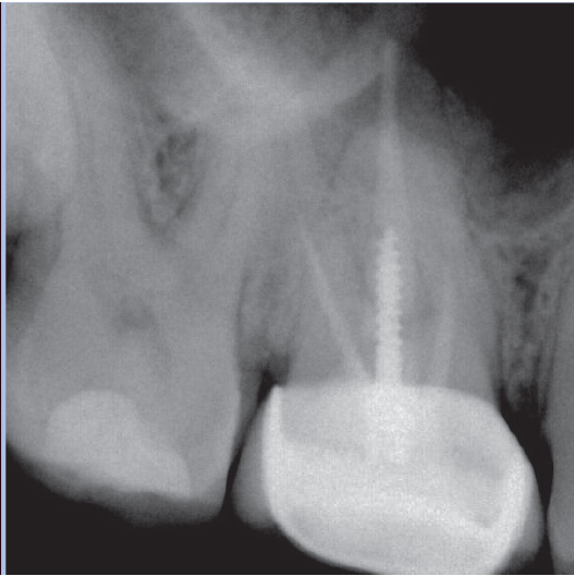 Before Root Canal treatment