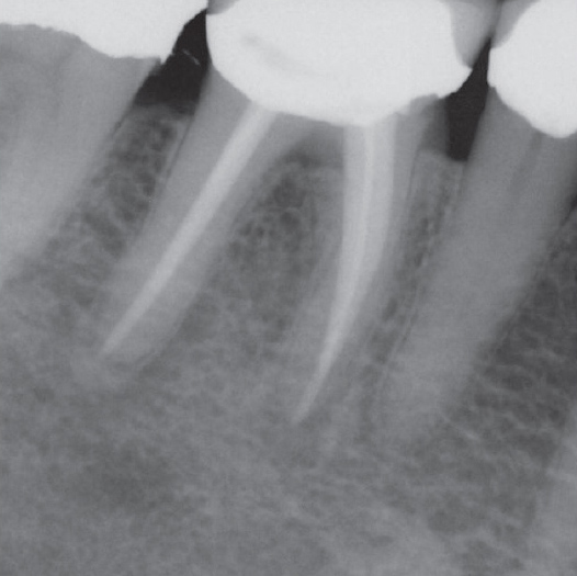 After Root Canal treatment