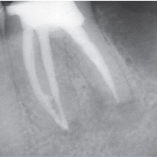 After Root Canal treatment