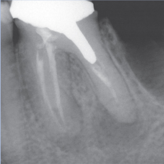 Before Root Canal treatment
