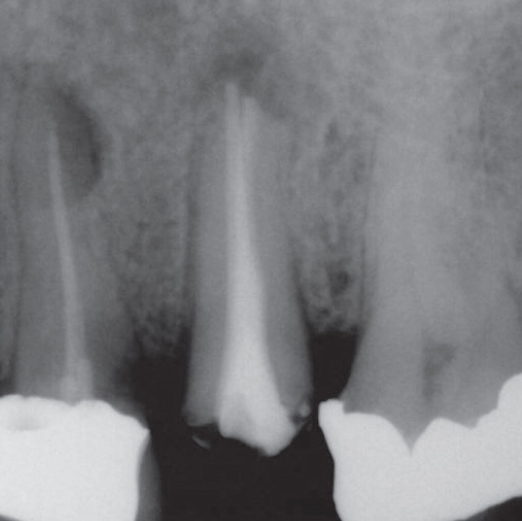 After Root Canal treatment