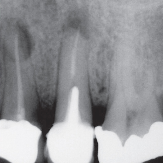 Before Root Canal treatment