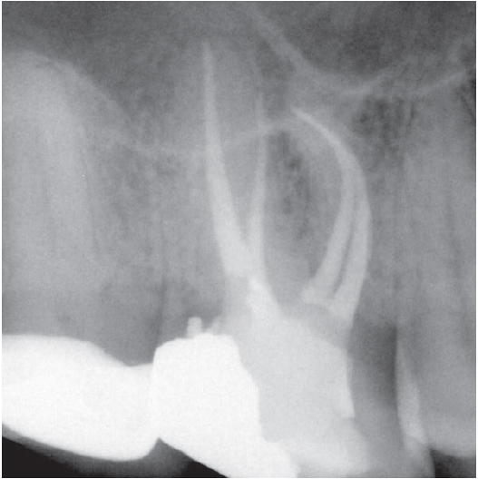 After Root Canal treatment