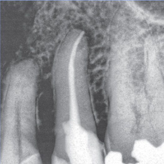 After Root Canal treatment