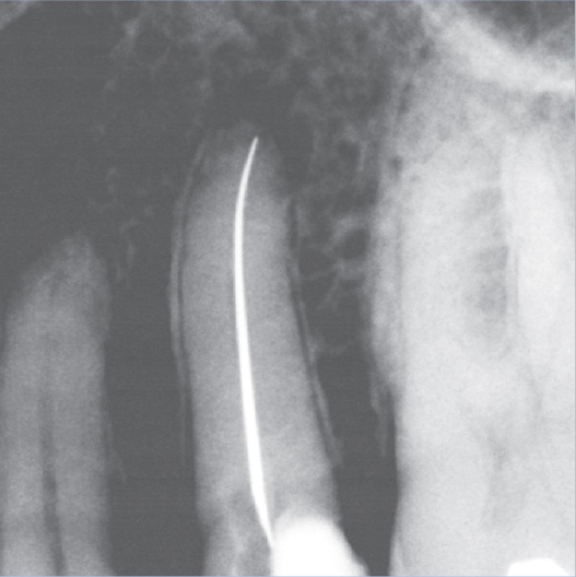 Before Root Canal treatment