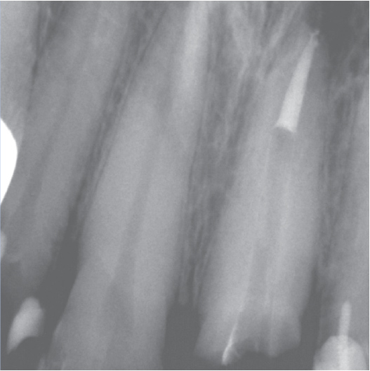 After Root Canal treatment