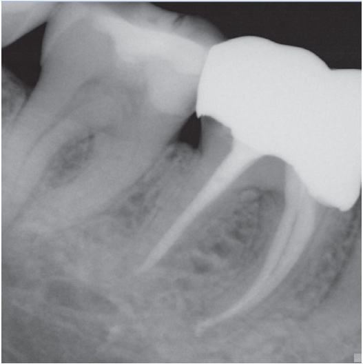 After Root Canal treatment