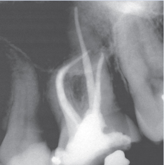 After Root Canal treatment