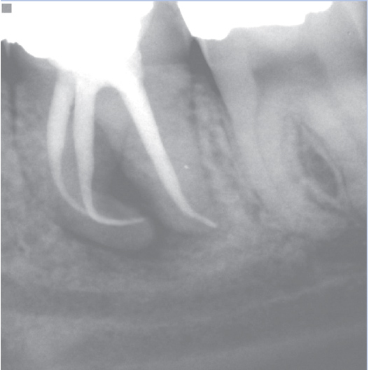 After Root Canal treatment
