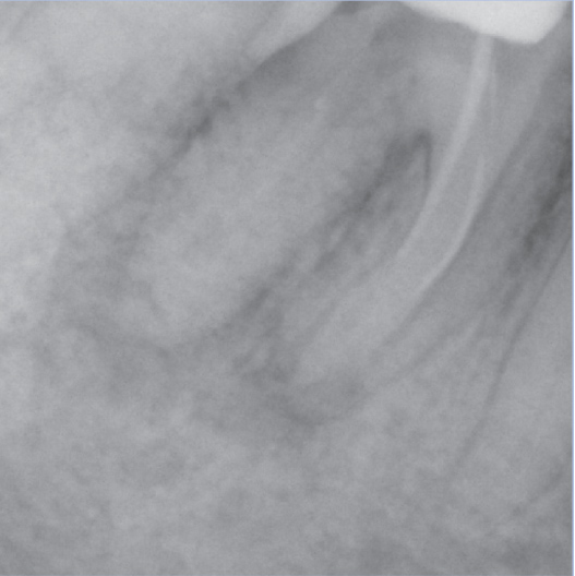 Before Root Canal treatment