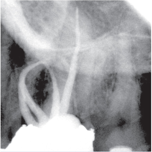 After Root Canal treatment