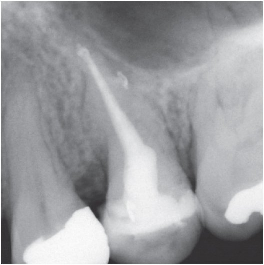 After Root Canal treatment