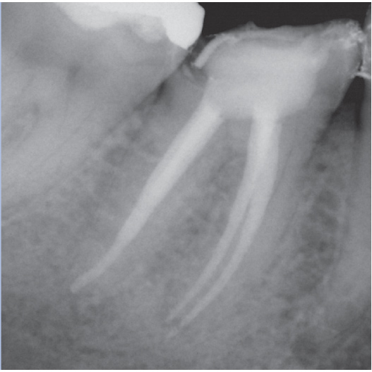 After Root Canal treatment