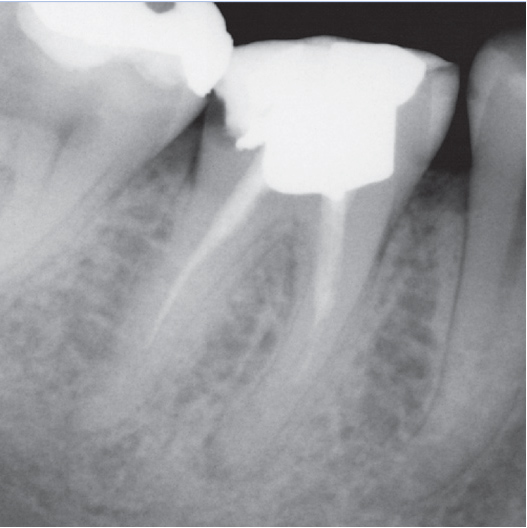 Before Root Canal treatment