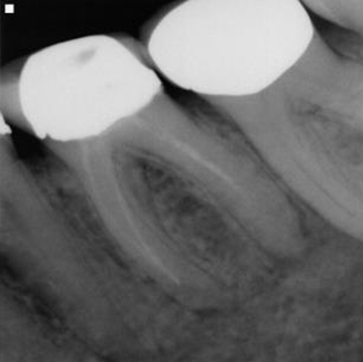 Before Root Canal treatment