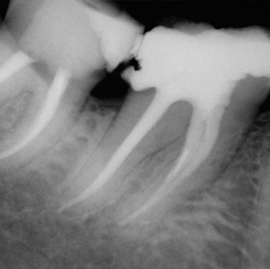 After Root Canal treatment