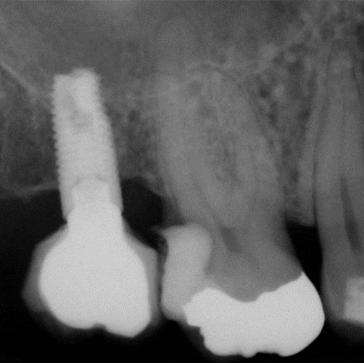 Before Root Canal treatment