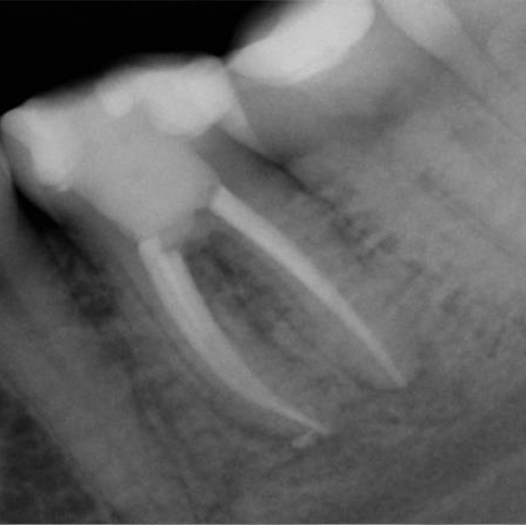 After Root Canal treatment
