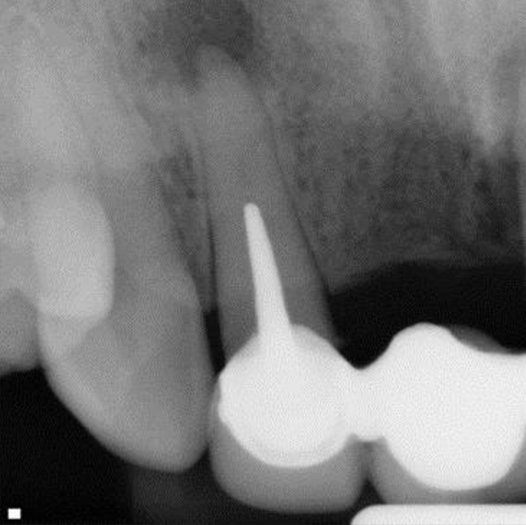 Before Root Canal treatment