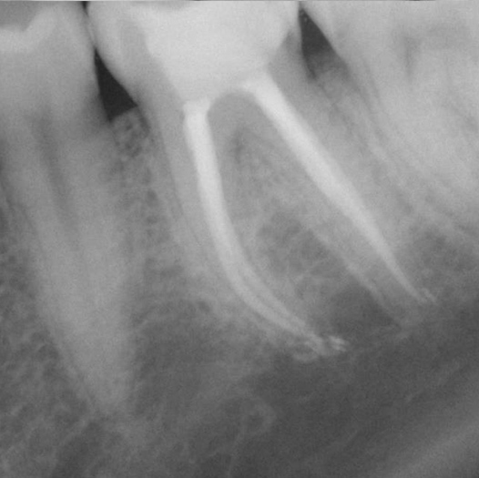 After Root Canal treatment