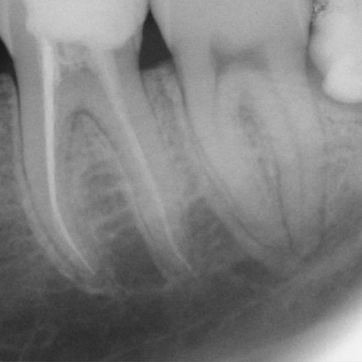 Before Root Canal treatment