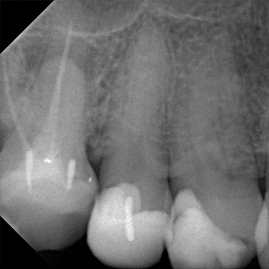 Before Root Canal treatment