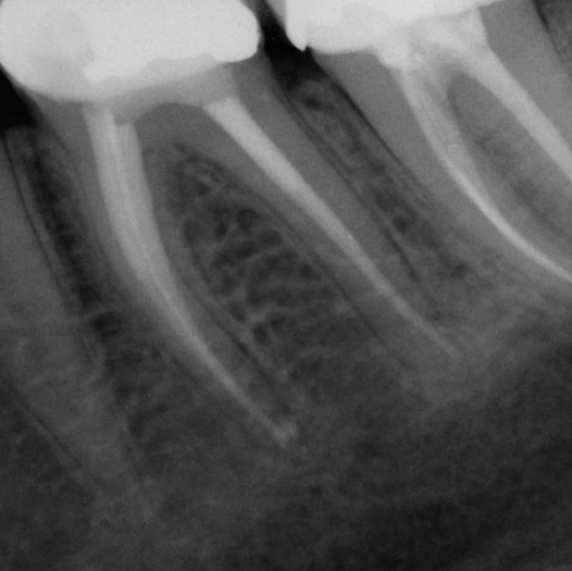 After Root Canal treatment