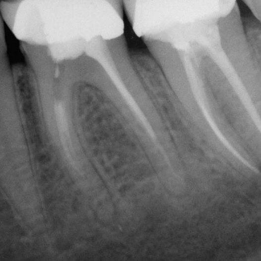 Before Root Canal treatment