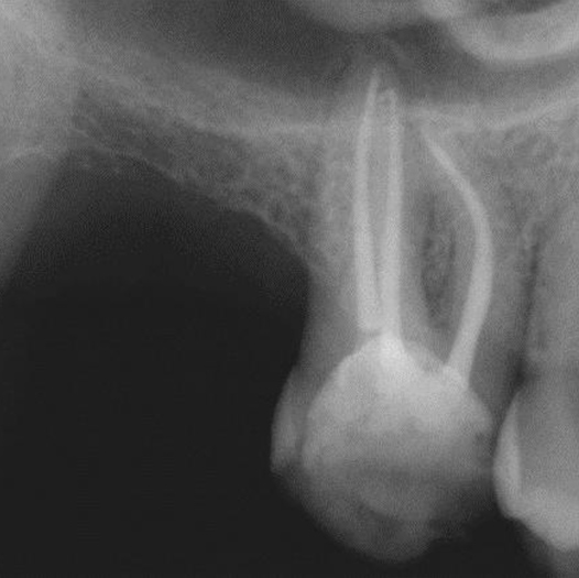 After Root Canal treatment