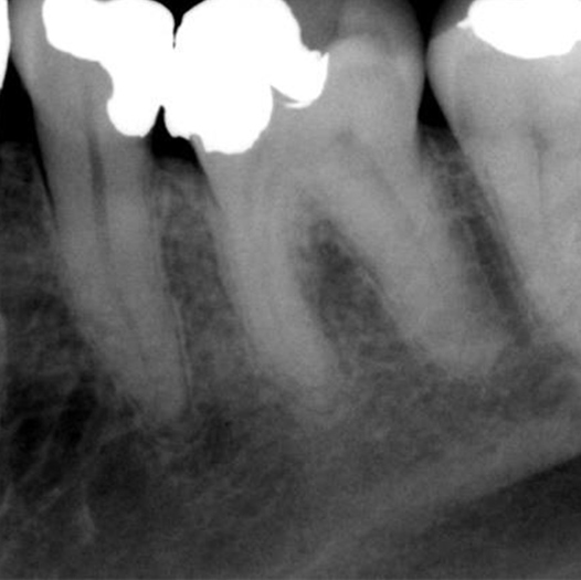 Before Root Canal treatment