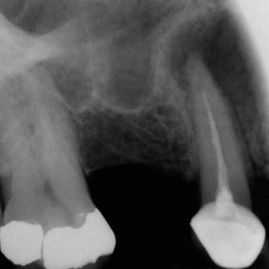 Before Root Canal treatment