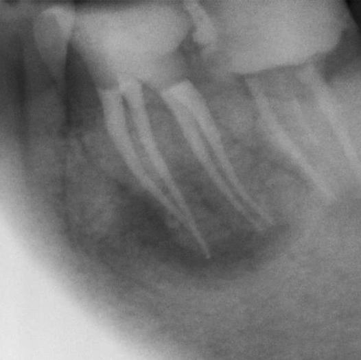 After Root Canal treatment