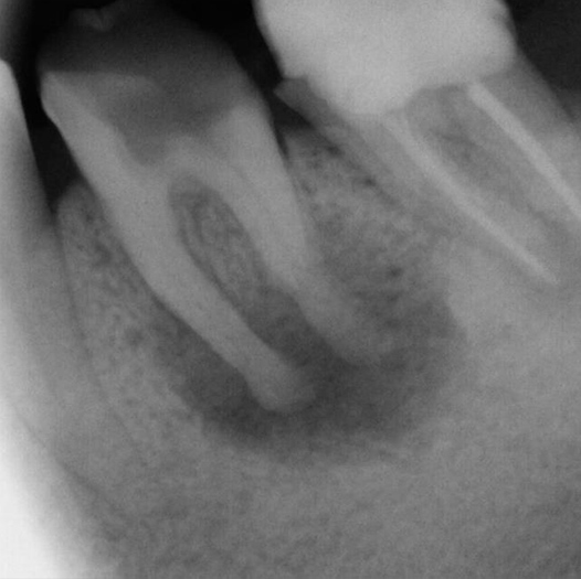 Before Root Canal treatment