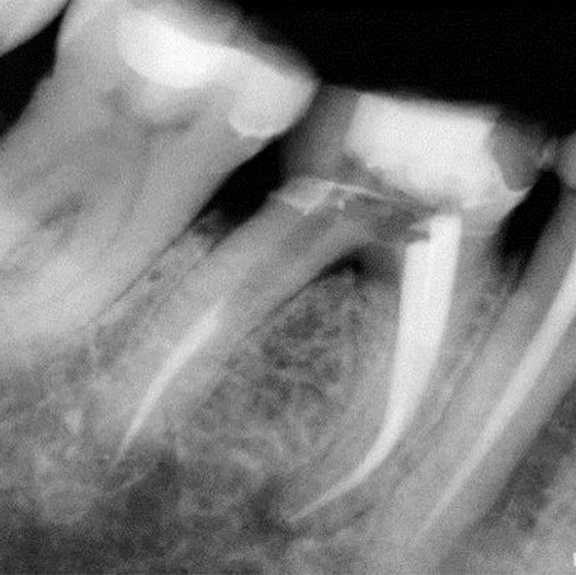 After Root Canal treatment