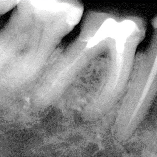 Before Root Canal treatment