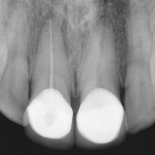 Before Root Canal treatment