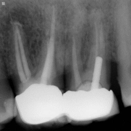 After Root Canal treatment