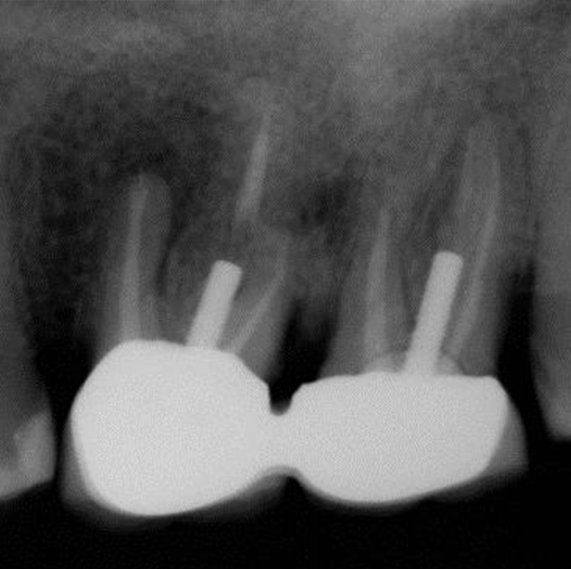 Before Root Canal treatment