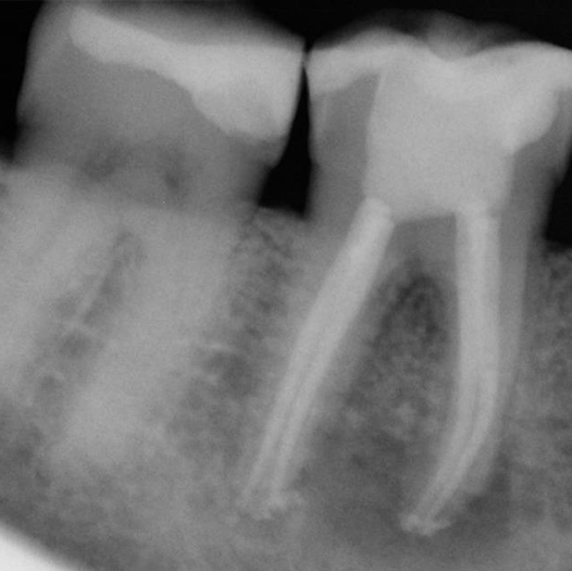 After Root Canal treatment