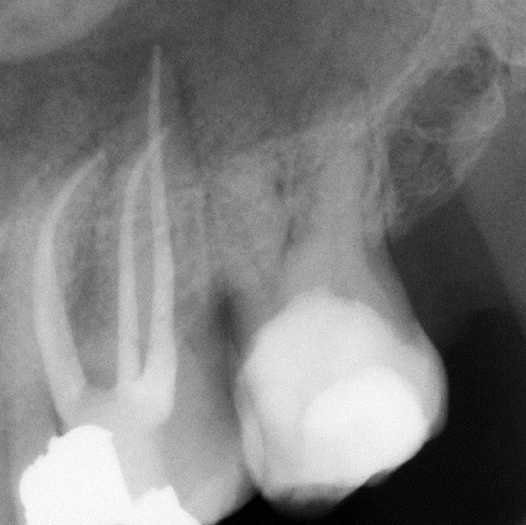 After Root Canal treatment