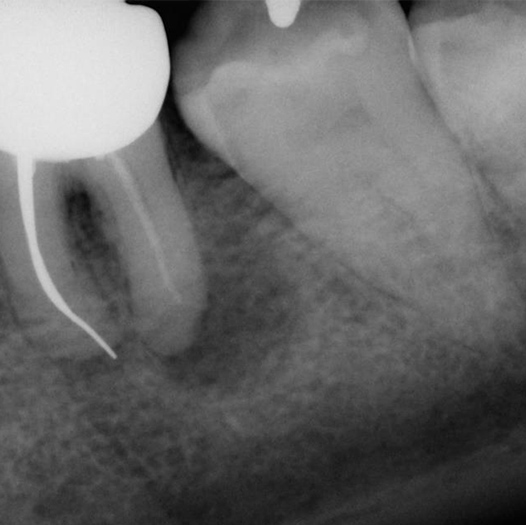 Before Root Canal treatment