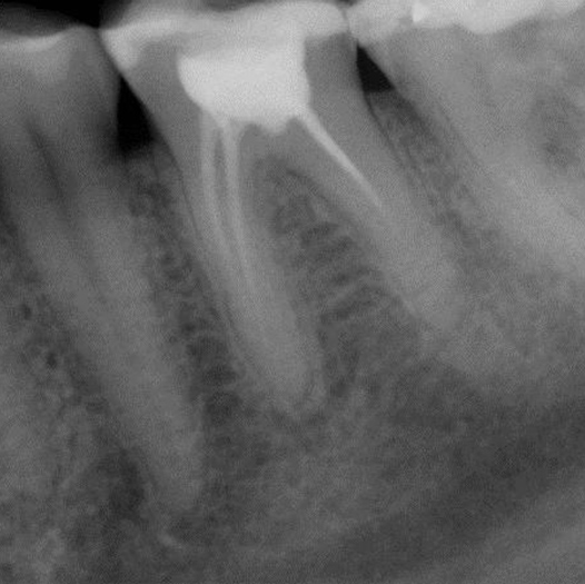 Before Root Canal treatment